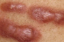 Ăn rau muống khiến sẹo lồi