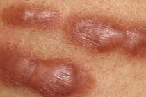 Ăn rau muống khiến sẹo lồi