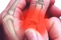 Dấu hiệu của ung thư xương