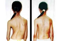 Dấu hiệu nhận biết trẻ bị vẹo cột sống
