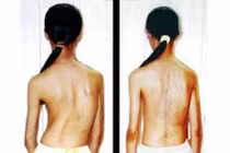 Dấu hiệu nhận biết trẻ bị vẹo cột sống