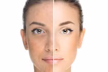 Lợi và hại của làm trắng da