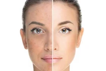 Lợi và hại của làm trắng da