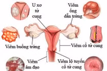 Vợ viêm âm đạo sau mỗi lần quan hệ