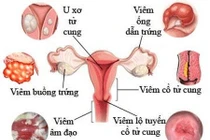 Vợ viêm âm đạo sau mỗi lần quan hệ