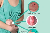 Phát hiện các bệnh lý dễ phát sinh ung thư dạ dày