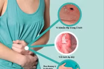  Phát hiện các bệnh lý dễ phát sinh ung thư dạ dày