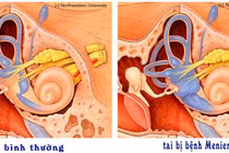 Tai ù do sũng nước mê nhĩ