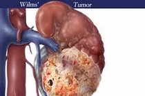 U nguyên bào thận ở trẻ