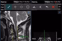Liệt vì tự đi chữa bệnh cột sống