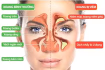 Biện pháp tổng thể điều trị viêm xoang mũi