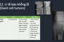 Đau vai do u xương tế bào khổng lồ