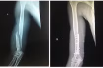 Gãy tay vì không khởi động