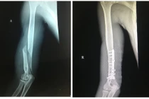 Gãy tay vì không khởi động