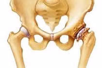Đau khớp háng cẩn thận hoại tử chỏm xương đùi