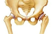 Đau khớp háng cẩn thận hoại tử chỏm xương đùi