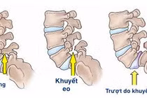 Đau lưng do khuyết eo đốt sống ở người trẻ