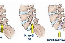Đau lưng do khuyết eo đốt sống ở người trẻ
