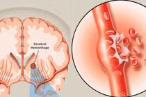 Cấp cứu đột quỵ chảy máu não do tăng huyết áp 
