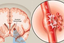 Cấp cứu đột quỵ chảy máu não do tăng huyết áp 