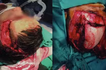 Kích hoạt báo động đỏ cứu bệnh nhân vỡ hộp sọ do kẹp thang máy