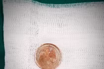 Bé 5 tuổi suýt mất mạng vì nuốt đồng xu