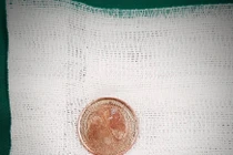 Bé 5 tuổi suýt mất mạng vì nuốt đồng xu