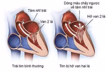 Sự khác nhau giữa hở và hẹp van hai lá