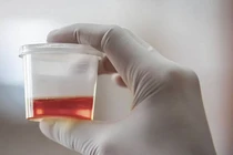 Tiểu ra máu sau quan hệ tình dục 