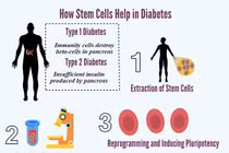 Ghép tế bào gốc có điều trị khỏi đái tháo đường?