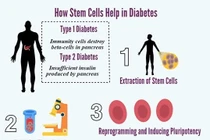 Ghép tế bào gốc có điều trị khỏi đái tháo đường?