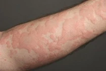 Mưa nhiều nổi mề đay