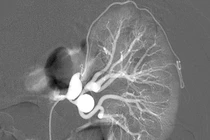 Nút mạch điều trị dị dạng động tĩnh mạch thận 