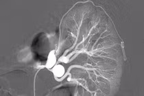 Nút mạch điều trị dị dạng động tĩnh mạch thận 