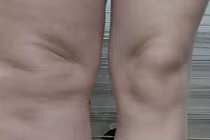 Cứ tưởng chân sưng do đau xương, nào ngờ phù bạch mạch nguy hiểm