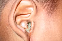 Chảy dịch tai sau mổ