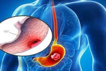 Xét nghiệm chẩn đoán ung thư dạ dày