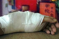 Gãy xương có nên bó lá?