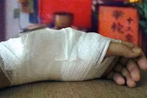 Gãy xương có nên bó lá?