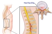Tổn thương thần kinh do hẹp ống sống