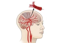 Nhồi máu não diện rộng là gì? Điều trị bằng cách nào?