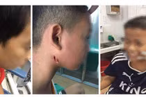 3 trẻ nhỏ xứ Nghệ bị "vi khuẩn ăn thịt người" tấn công tuyến nước bọt mang tai