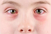 Mắt bị đỏ là bệnh gì?