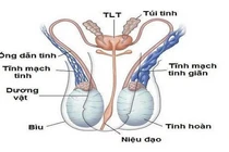 Giãn tĩnh mạch thừng tinh dễ gây vô sinh