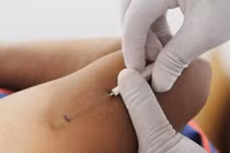 Sử dụng miếng dán và cấy que tránh thai sau sinh