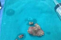 Phương pháp tán sỏi ngoài cơ thể chỉ áp dụng sỏi nhỏ