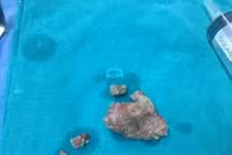 Phương pháp tán sỏi ngoài cơ thể chỉ áp dụng sỏi nhỏ