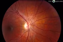 Ngộ độc thị thần kinh do rượu