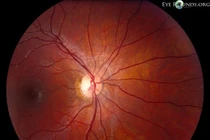 Ngộ độc thị thần kinh do rượu