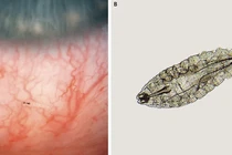 Viêm hốc mắt do ấu trùng ruồi xâm nhập 